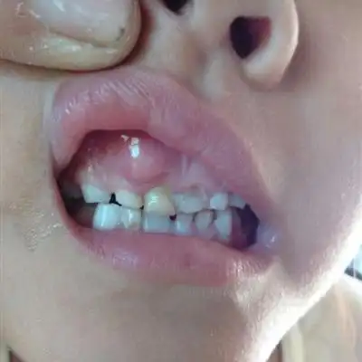 婴儿马牙怎么治