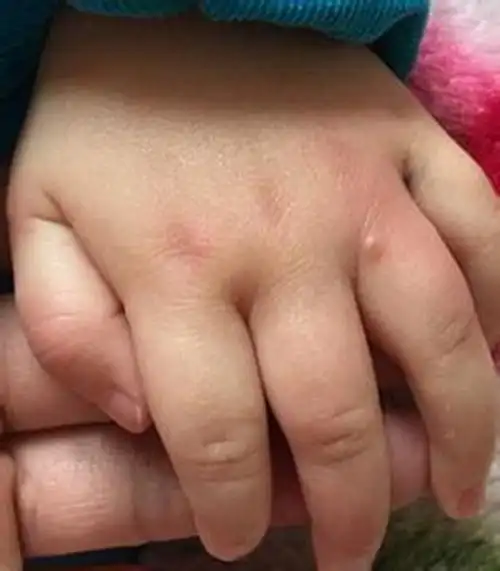 小朋友手足口病的图片