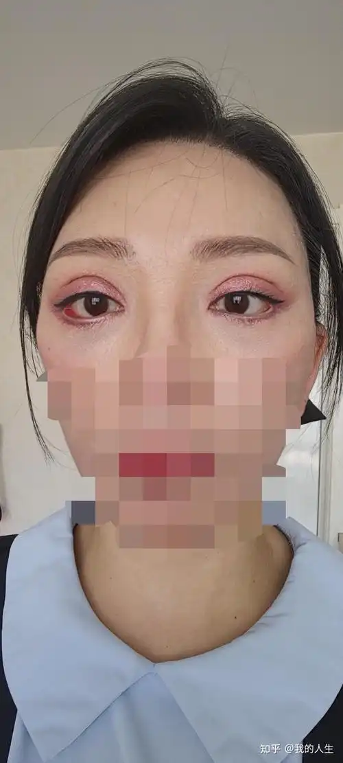 我的眼睛三四年前做下眼袋全切,组织切多了导致下眼睑外翻,现在还可以