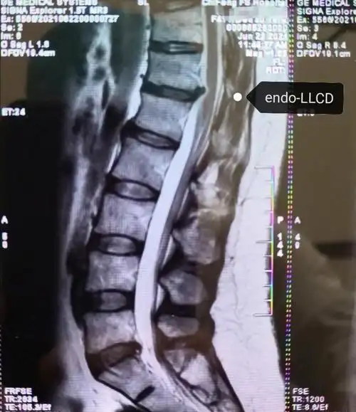 术前核磁:胸12-腰1椎间盘突出,胸椎管狭窄.内镜术中清晰显露硬膜囊.