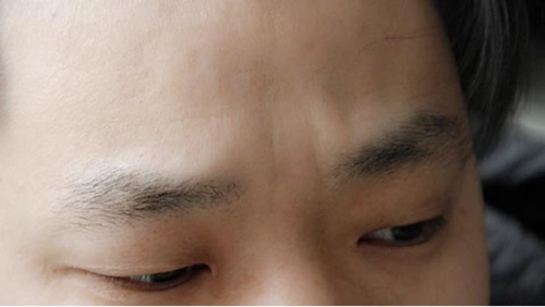 眉间有竖纹是怎么回事