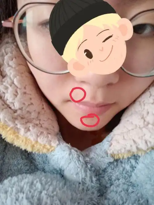 现在已经距离点痣快两个月了,恢复的还是挺好的,就还有点红印,激光点