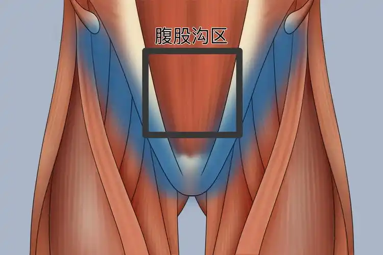 腹股沟直疝发生位置图
