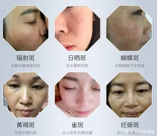 关于"斑"这个东西,相信广大女性朋友再熟悉和讨厌不过了,斑分很多种