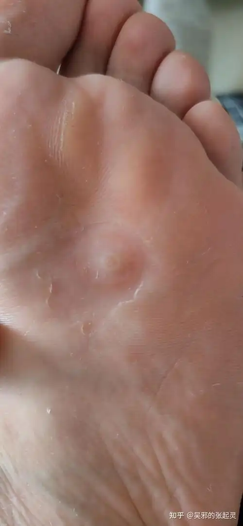 把跖疣当成了鸡眼好多天