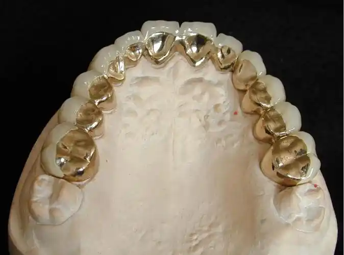 纯钛烤瓷牙是一种非贵金属烤瓷牙,是近几年才逐渐发展的金属烤瓷技术.