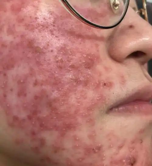 生完孩子后一直面部丘疹用过一段时间的尤卓尔后一直有炎性丘