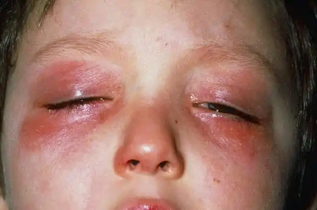 发现孩子眼睛红肿得很严重了,这才慌了神,立马把孩子送去了儿童医院