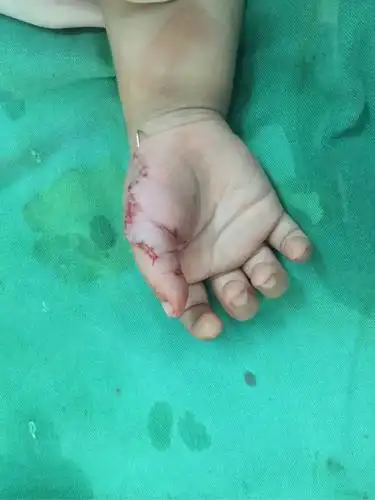 刚当了爸爸,男孩,孩子左手拇指多一个,六指,以后我该怎么向孩子解释