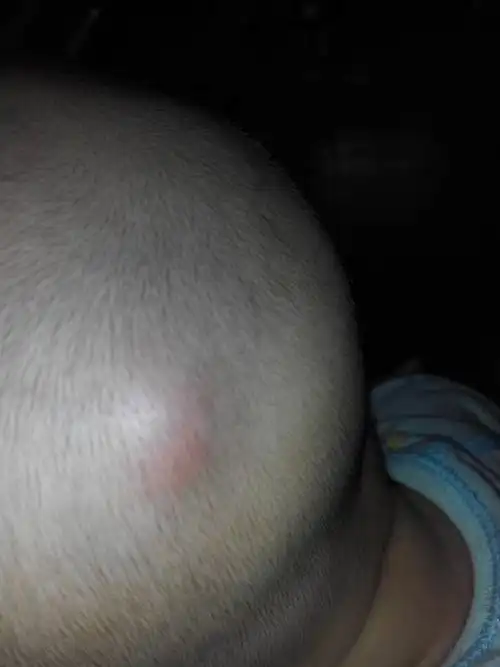 宝宝后脑勺不知道怎么就长了个包怎么办.