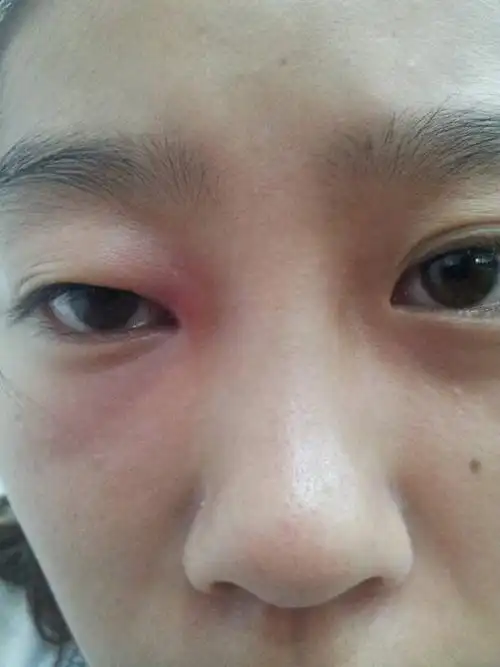 今天一个眼眶都是肿的,眼角能明显摸到