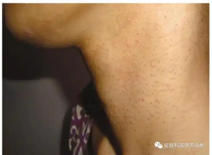 脖子长了鸡皮疙瘩其实是这种皮肤病