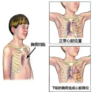 漏斗胸要10岁前"补漏"