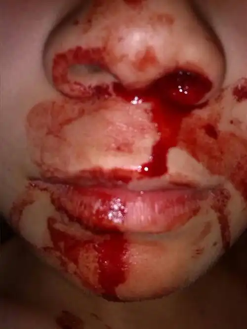 出鼻血了,止不住,救命,咋办