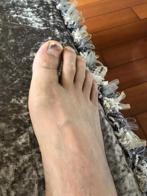 大脚趾甲发黑,吓得半死