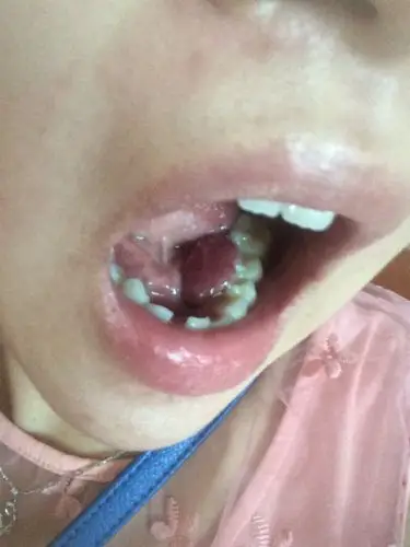 5个多月的牙龈瘤,好像3个月的时候开始的差不多,现在已经很大很大很