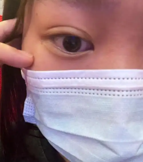 下至的时候感觉怎么都不对,还有卧蚕那里有一条线的感觉,这是眼尾沟吗