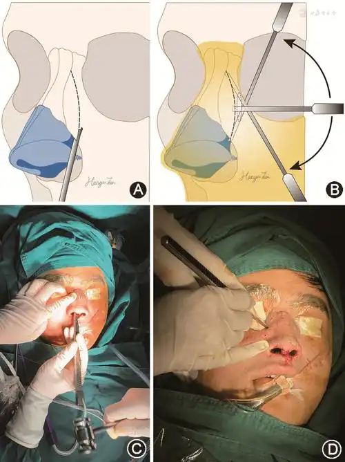 继续教育园地 | 鼻背畸形矫正中的关键技术——截骨术_骨质_手术_韧带