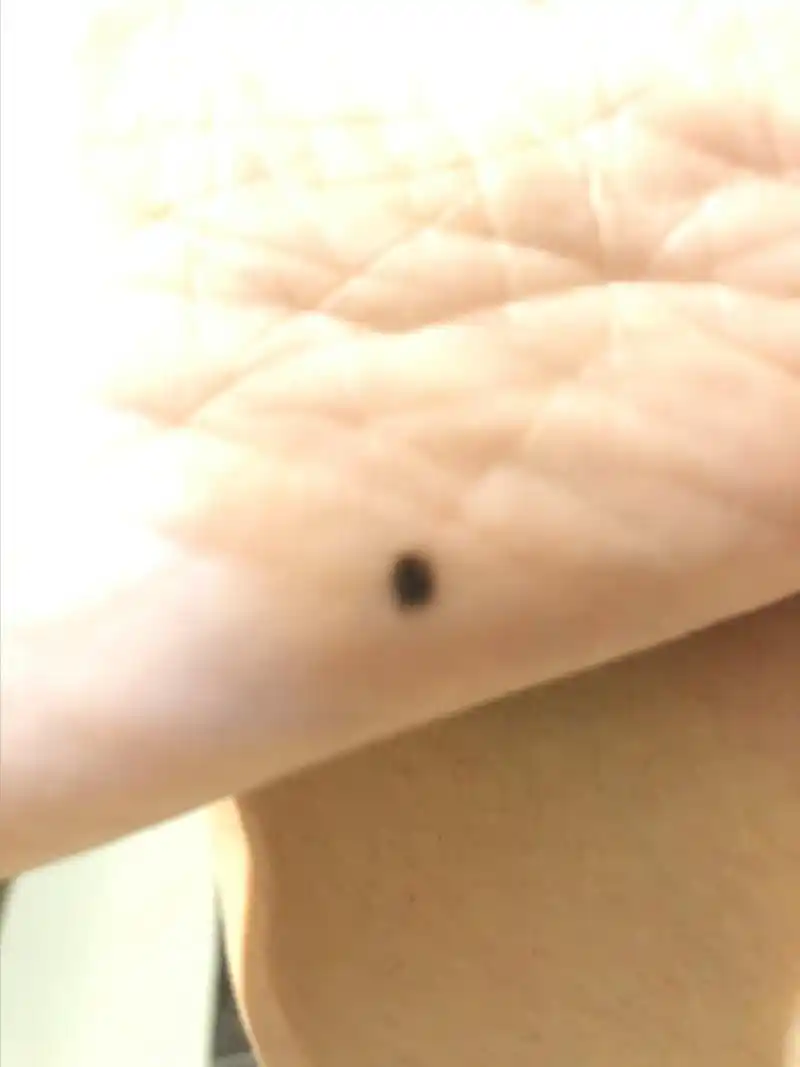 脚底板突然长痣 这颗痣应该是最近两三年长出来,感觉越来越黑,越来越