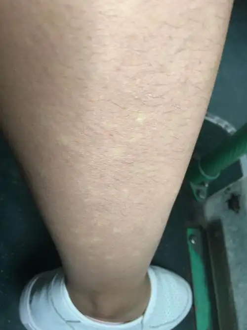 小腿长很多白点,不痛不痒,已有多年,一直没管它.