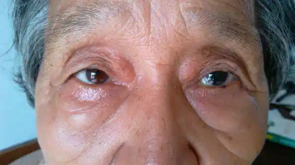 判断血脂高不高,看一眼就明白