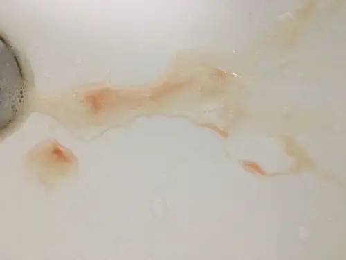 24岁男9月20号左右开始痰中带血10月1日去医院检查