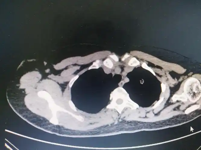 写美篇患者彭某,52岁女性,患者2018年3月确诊为乳腺癌,当时ct发现左上
