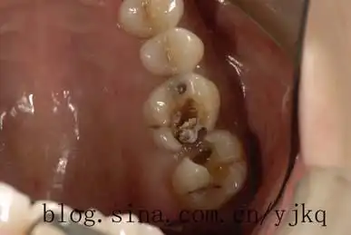 龋齿治疗的问题