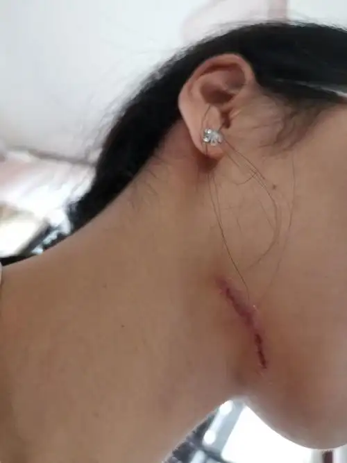 切除了伴随近三十年的胎记黑毛痣记录下吧