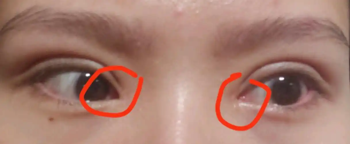 双眼皮47天了,感觉割宽了,深了,两个_新氧-专业医美服务平台