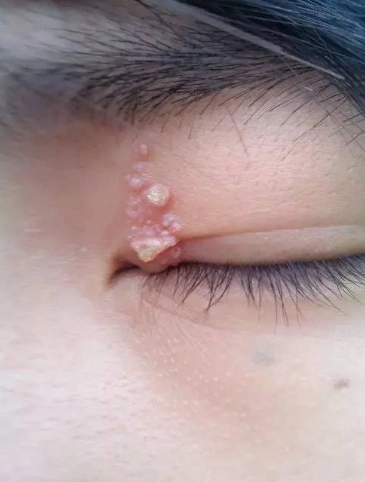 汗管瘤图片眼部图片 (4)