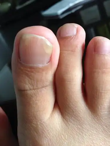 脚指甲感觉空了,里面还能挖出白白的东西,剪掉还是会空,以前只有一只