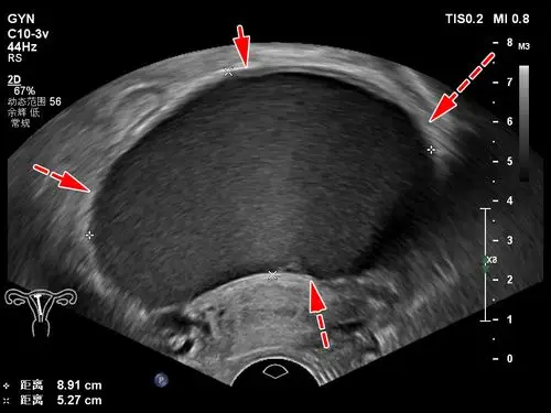 简单分享一个病例:孟彬:超声介入微创穿刺硬化治疗卵巢巧克力囊肿