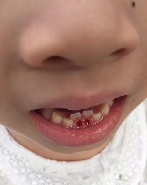 孩子为什么长双排牙?别再这样喂孩子了