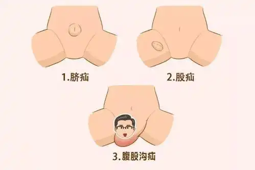 腹股沟部位有肿块小儿疝气的危害不容小觑