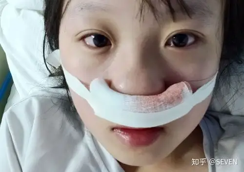 鼻窦炎鼻息肉手术记录