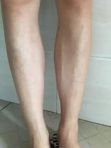 腿上静脉曲张怎么办呀 腿上静脉曲张疼怎么办- 育儿指南