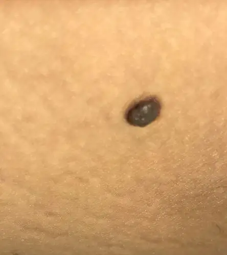 各位,腿上长了个这个东西,这是啥?怎么治疗?需要治疗吗?