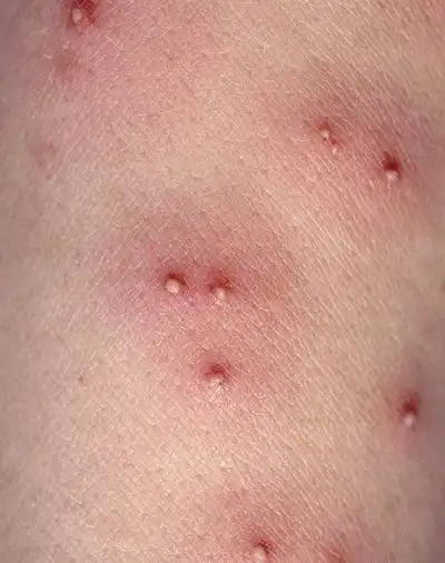 艾滋病窗口期皮疹  (25)