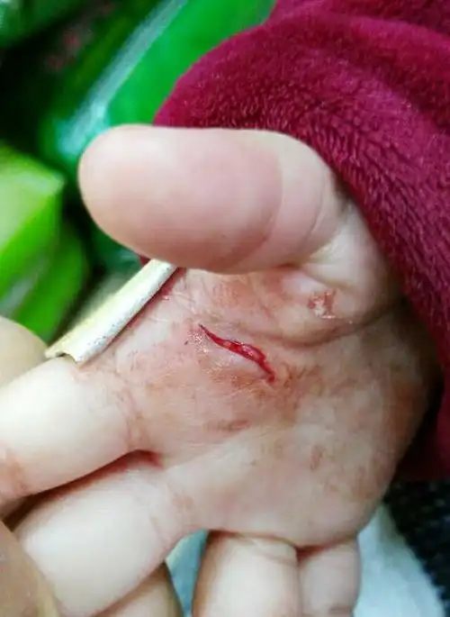 [2013年6月妈妈帮]宝宝割伤手需要去诊所清理吗?