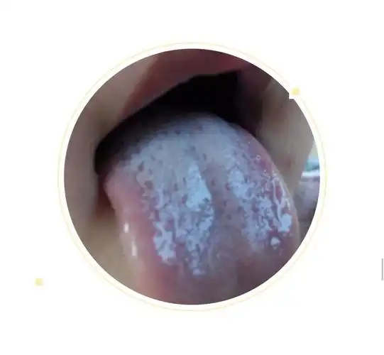 如果我们的身体里津液不足,舌头上就会有红点点,或者舌尖红.