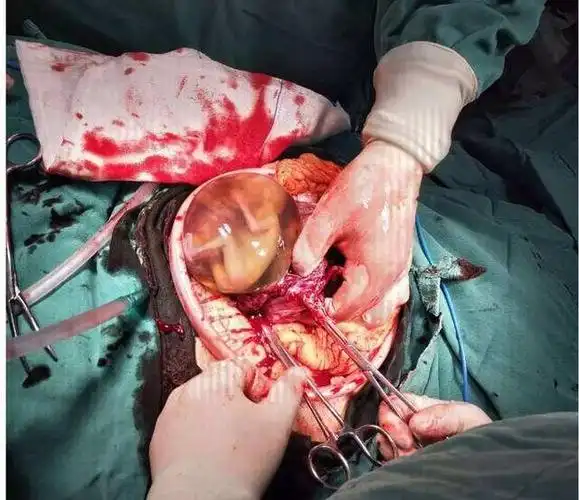 生小孩宫颈裂开图片,生孩子宫颈口撕裂图片-图片大观-奇异网