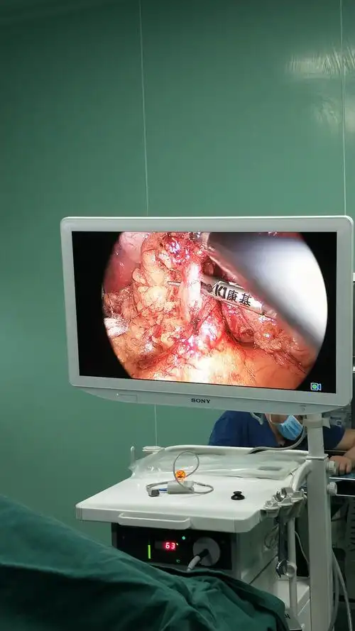 海南州人民医院普外科完成海南州首例单孔腹腔镜下胃癌根治全胃切除术