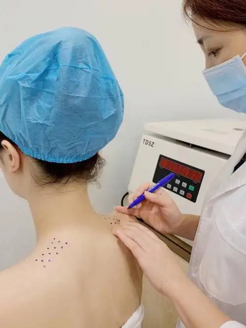 分享打瘦肩针的干货