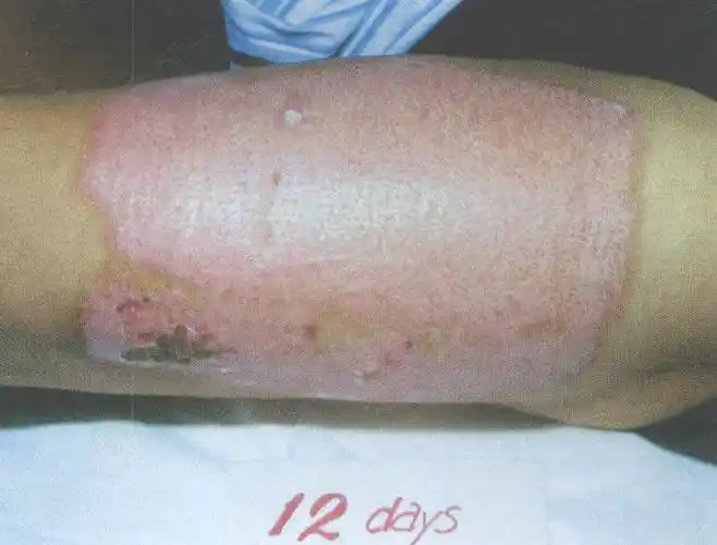 薄供皮区; b.2周内愈合不会发生瘢痕增生