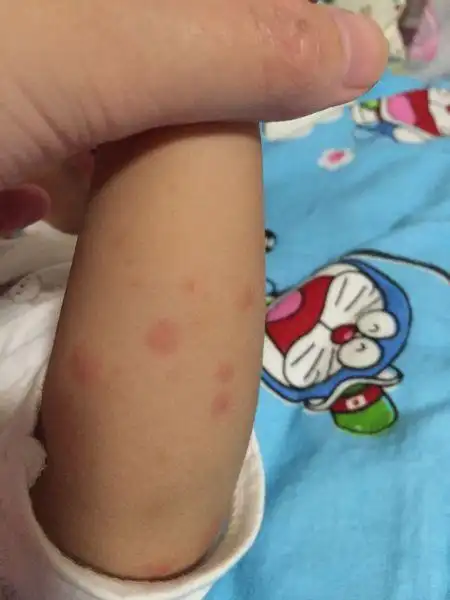 当妈的我好愁,两只小胳膊一直起这些疹子,怎么办?