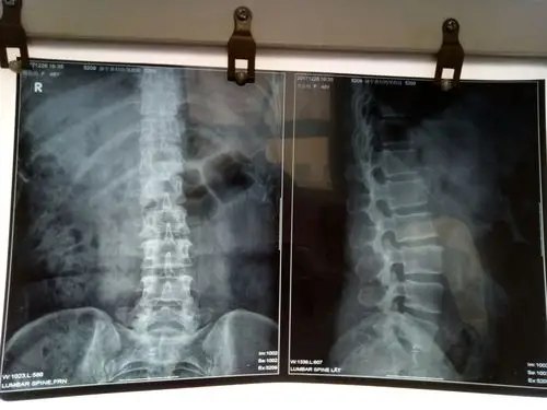 腰椎间盘突出症的微创治疗与康复锻炼.