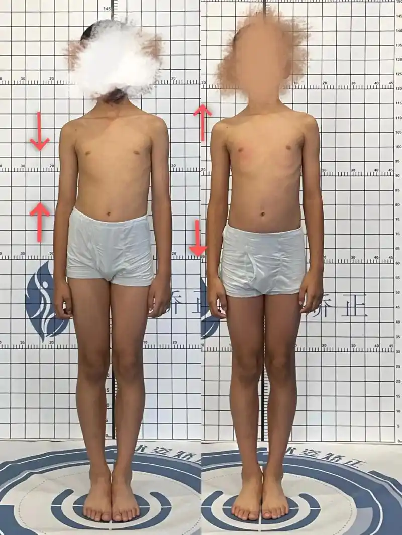 8岁孩子驼背.家长描述是觉得驼背,单通过观察不难发现是身体重 - 抖音