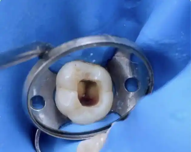 科普丨规范化根管治疗流程