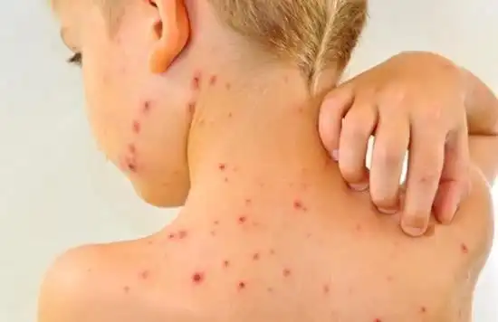 幼儿水痘初期症状图片,幼儿水痘初期症状-图片大观-奇异网